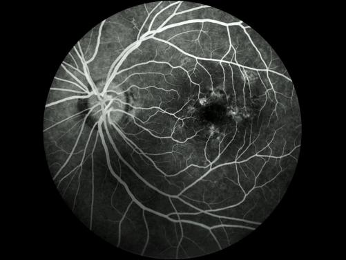 SK-650B Non-mydriatic Fundus Camera and FLUORESCEION ANGIOGRAPHY