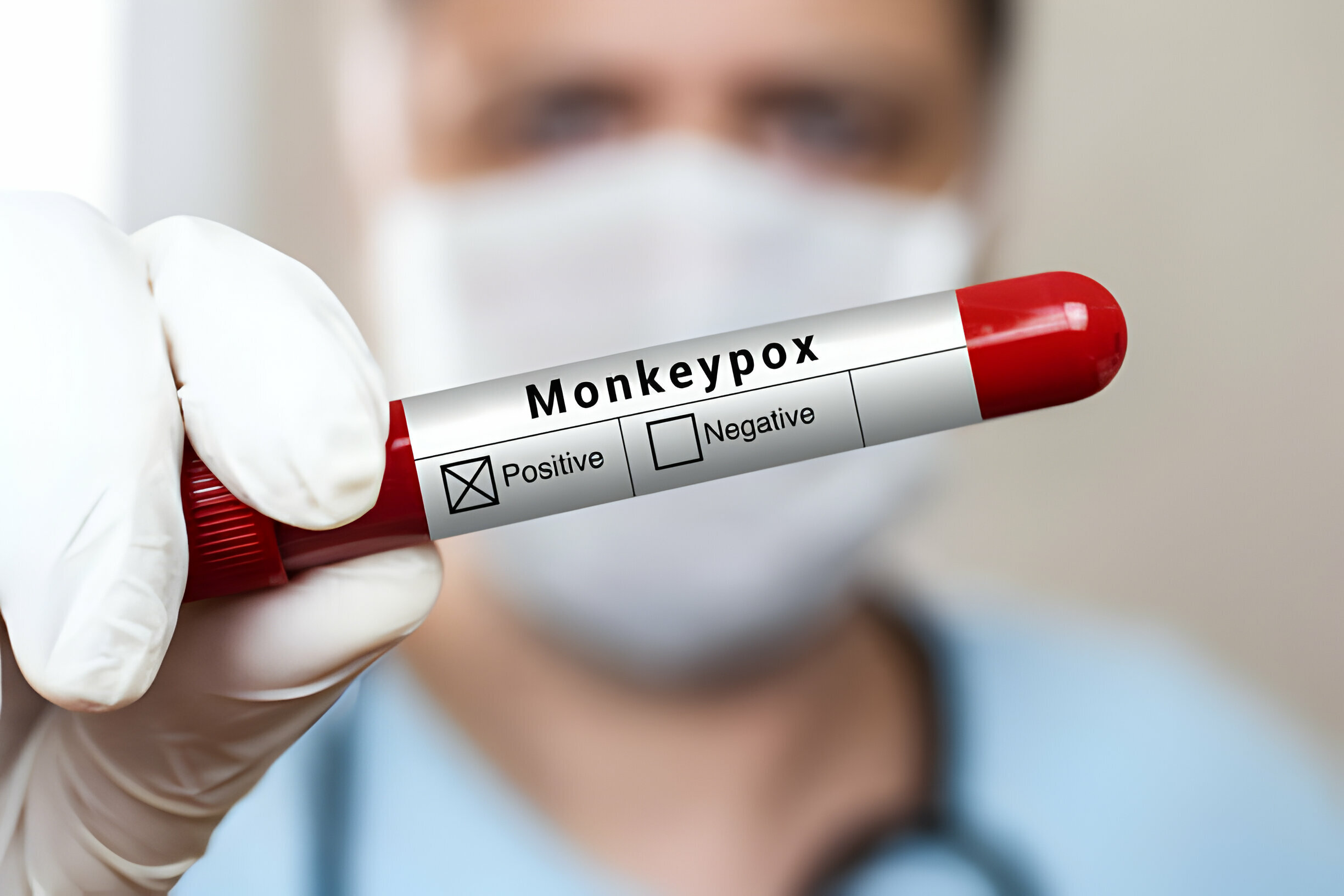 The Role of Throat Swabs in Monkeypox Testing