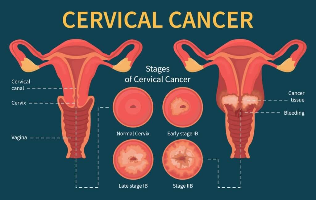 Cervical cancer infographic. Stage of disease. Female reproductive system.