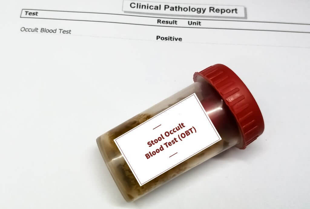 Stool sample container for occult blood test (OBT) with abnormal patient's report.