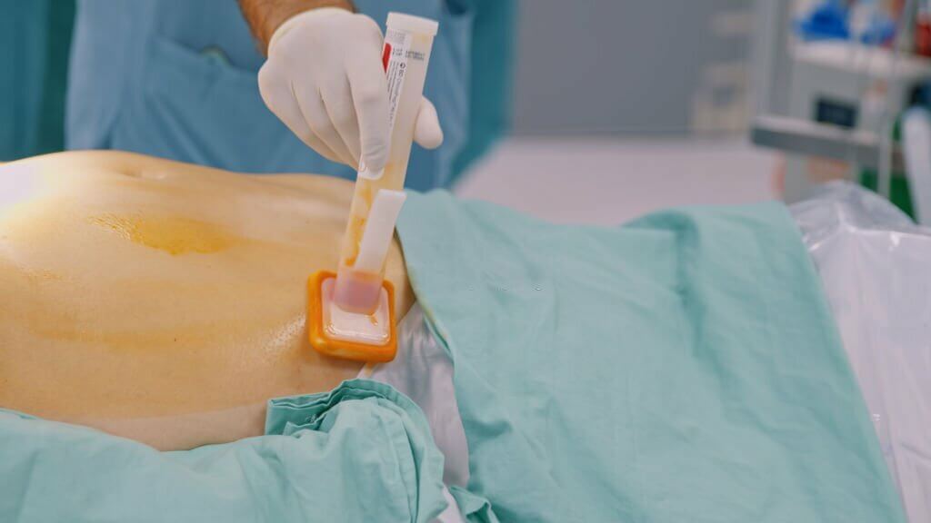 Treatment of the patient's abdomen with iodine solution before surgery.