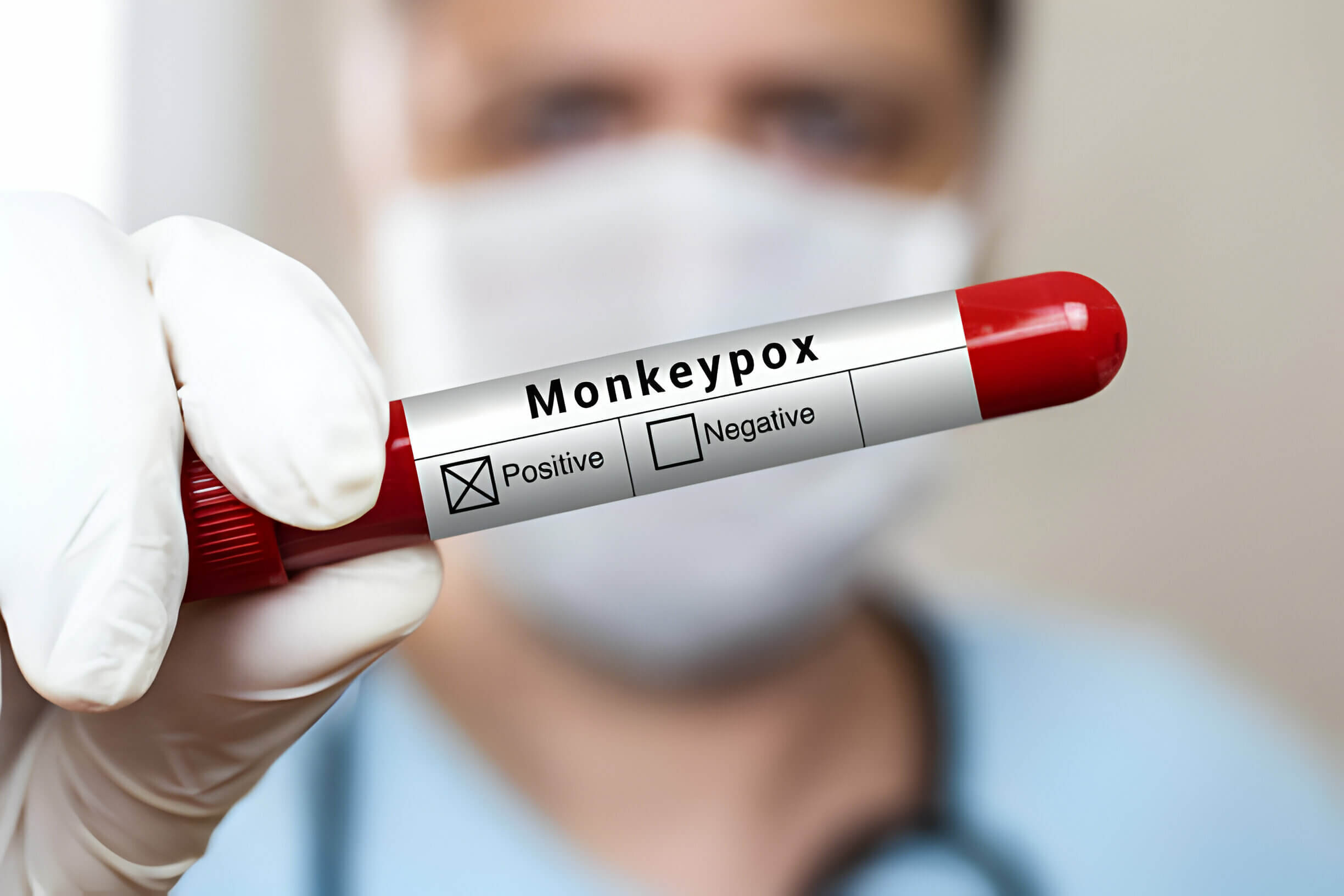 Doctor holding Monkeypox
